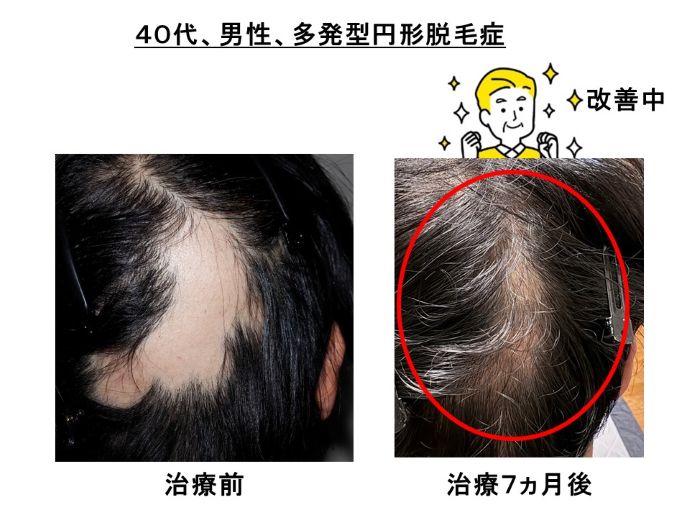 円形脱毛症　病院